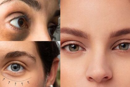 Dark Circles
